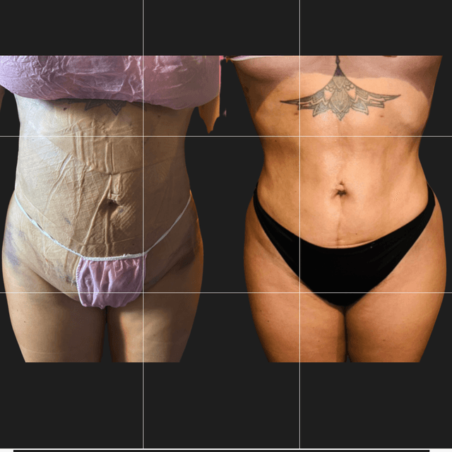 ✨Post-Op Care(Lipo/BBL/TummyTucks at Nena’s Beauty Glow Bar in North Las Vegas, NV