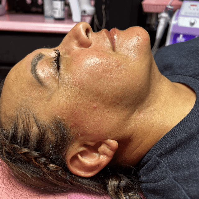 ✨Post-Op Care (ChinLipo/Facelifts)✨ at Nena’s Beauty Glow Bar in North Las Vegas, NV