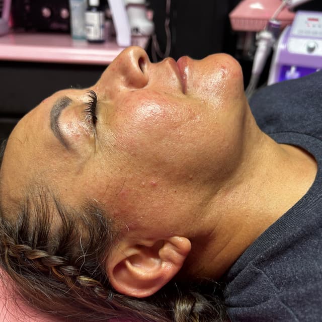 ✨Post-Op care(ChinLipo/face-lift)✨ at Nena’s Beauty Glow Bar in North Las Vegas, NV