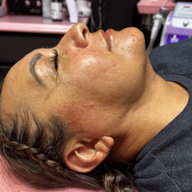 ✨Post-Op Care(Chin Lipo/Facelift)✨ at Nena’s Beauty Glow Bar in North Las Vegas, NV