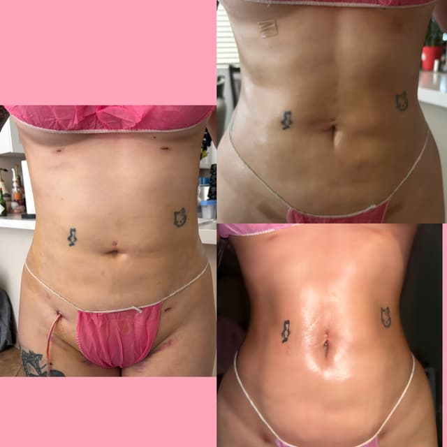 ✨Post-Op Care(Lipo/BBL/TummyTucks) at Nena’s Beauty Glow Bar in North Las Vegas, NV
