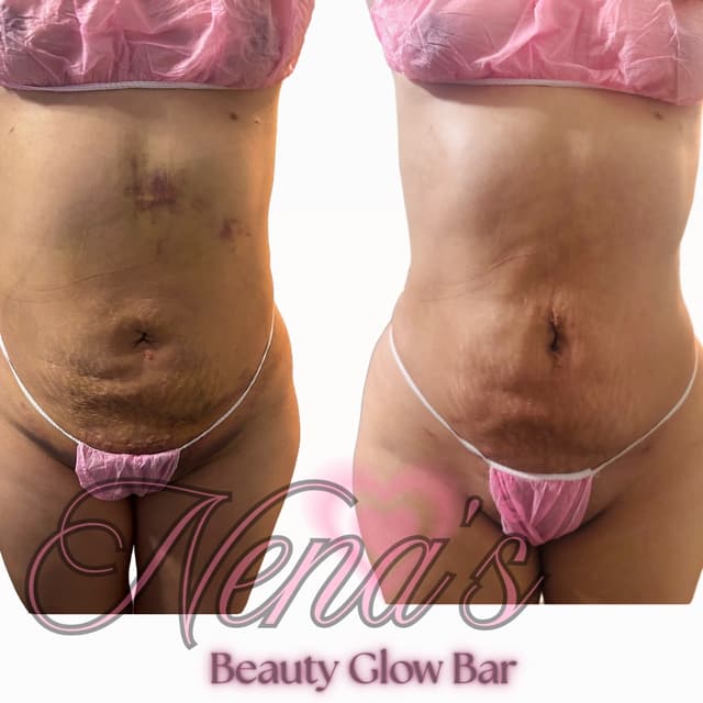 ✨Post-Op care(Lipo/BBL/TummyTucks✨ at Nena’s Beauty Glow Bar in North Las Vegas, NV