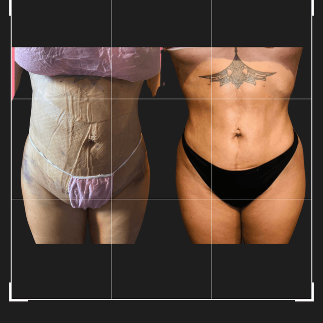 ✨Post-Op Care(Lipo/BBL/Tummytucks)✨ at Nena’s Beauty Glow Bar in North Las Vegas, NV